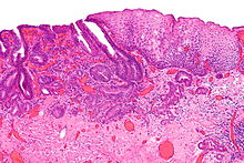 220px-Esophageal_adenocarcinoma_-_intermed_mag