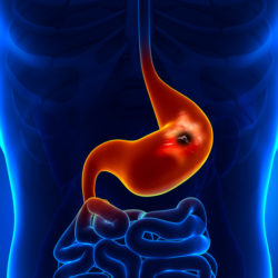 Stomach Ulcer