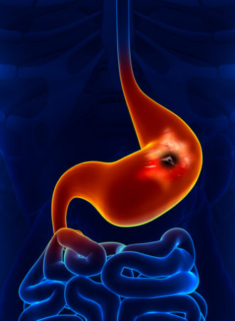 Stomach Ulcer