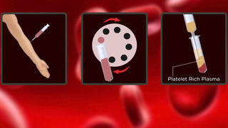 platelet rich plasma still